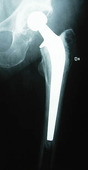 Röntgenbild av höftledsprotes