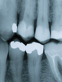 Röntgenbild på lagade tänder