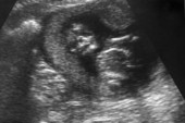 Ultraljudbild på foster